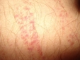Bacakta Kırmızı Lekeler Belirtileri ve Tedavisi Bacakta Kırmızı Lekeler Belirtileri ve Tedavisi