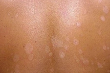 Vücutta beyaz Lekeler Neden Olur? Vücutta beyaz Lekeler Neden Olur?