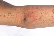 Kollarda Kırmızı Lekeler Belirtileri ve Tedavisi Kollarda Kırmızı Lekeler Belirtileri ve Tedavisi