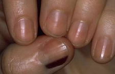 Tırnakta Siyah Leke Belirtileri ve Tedavisi Tırnakta Siyah Leke Belirtileri ve Tedavisi