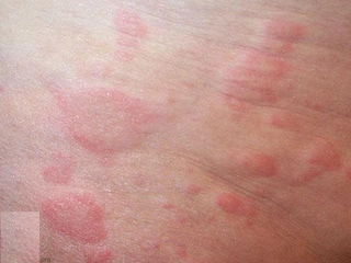 Deride Kırmızı Lekeler Belirtileri ve Tedavisi