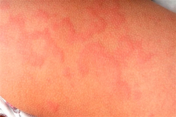Vücutta Kırmızı Lekeler Belirtileri ve Tedavisi Vücutta Kırmızı Lekeler Belirtileri ve Tedavisi