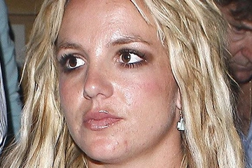 Yüzdeki Sivilce Lekeleri Nasıl Geçer? Yüzdeki Sivilce Lekeleri Nasıl Geçer?